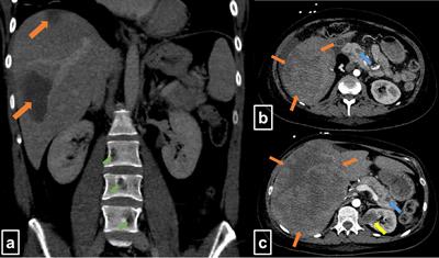 Vital Hepatic Lymphoma Residuum or Excessive Immune Response? Challenging Treatment Decisions in a Patient With Systemic Lupus Erythematosus and Liver-Dominant Diffuse Large B-Cell Lymphoma: Case Report